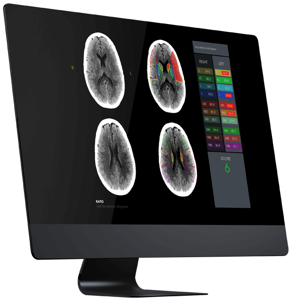 aspect-score-stroke-imaging-software-backed-by-research-from-rapidai